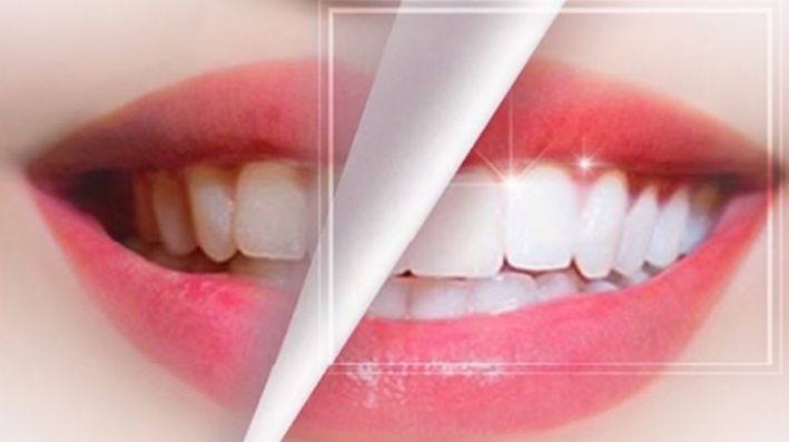 Tiras de clareamento dental antes e depois