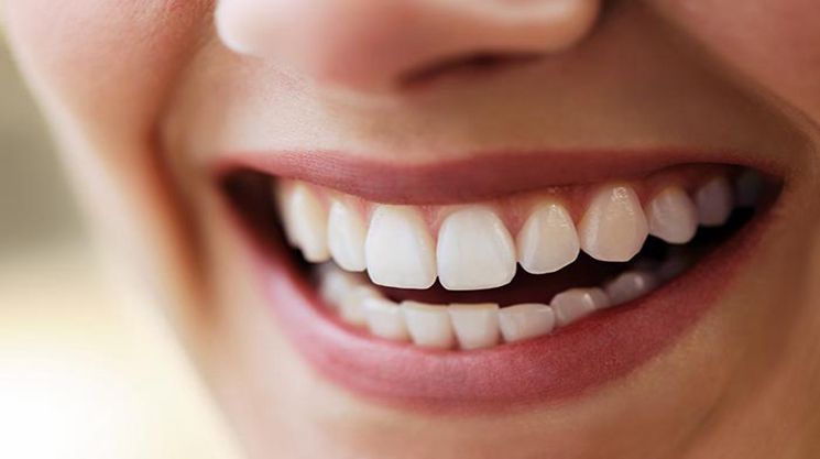 Clareamento dental sem peróxido: funciona e é seguro?